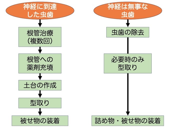 虫歯治療｜箕面市外院の歯科医院｜徳岡デンタルクリニック